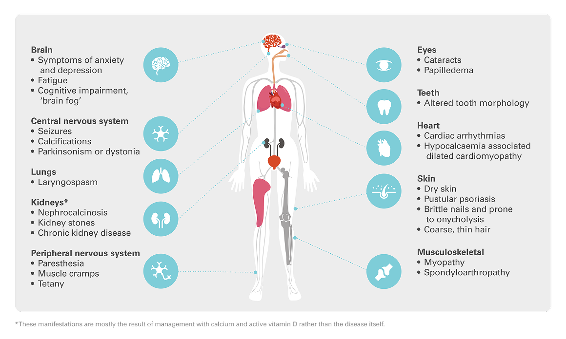 Hypopara symptom diagram sidepanel img